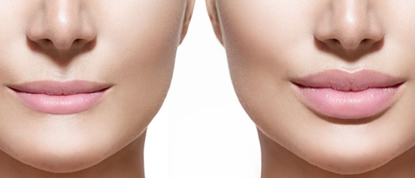 Рейтинг лучших филлеров для увеличения губ на 2026 год